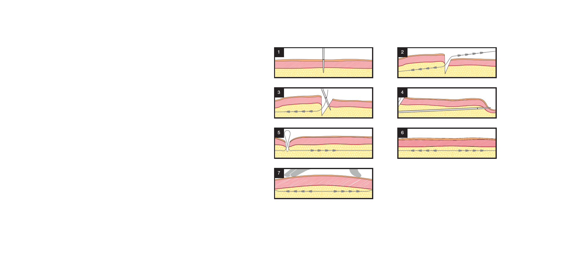 シルエットソフト 施術方法